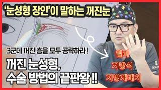 꺼진 눈성형, 수술방법의 끝판왕 !! 3군데 꺼진 층을 모두 공략하라 #꺼진눈성형