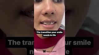 Braces On | Braces in Pakistan at Dental Aesthetics