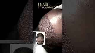 Hair Transplant | Care4Hair #beforeandafter