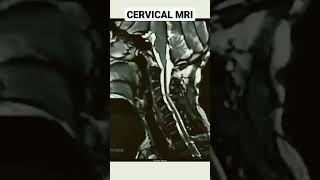 Cervical MRI#shorts #mri #physicaltherapy #anatomy #movement #innovation #cervical #spine