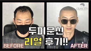 두피문신으로 탈모극복 리얼 후기 - 그레이시티