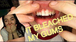 WHITENING MY TEETH GONE WRONG