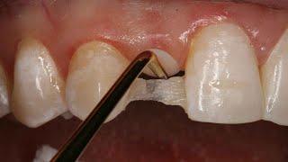 Direct Resin Bonded Bridge | Dental Online Training