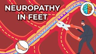 Dealing with Neuropathy in Feet: Causes, Symptoms, and Treatments