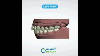 Teeth Alignment Aligners in Delhi || How Teeth Aligners work || Glamyo Health Dental