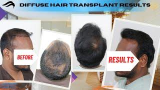 Hair Transplant In Salem | Best Cost Surgeon Center & Results Of Hair Transplant In Salem