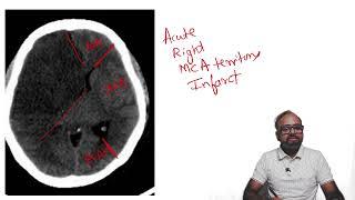 SPOTTERZ - 03 -  Brain hypodensity in a typical vascular territory