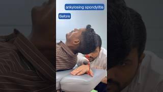 ankylosing spondylitis before and after chiropractic adjustment #trend #feed #feedshort #ytviral