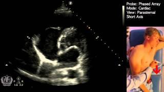 Parasternal Short Axis View - Transthoracic Echocardiography (Ultrasound)