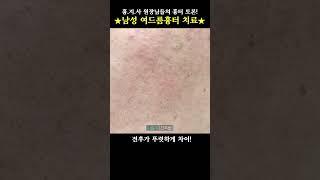 ⭕ 전후차이가 극명한 남성 여드름흉터! #박스카 #박스카흉터 #Boxcar #여드름흉터 #볼여드름흉터 #볼패인흉터 #남자여드름흉터 #새살침