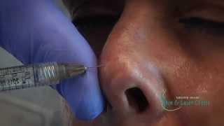 Correcting a non traumatic defect on the tip of the nose.