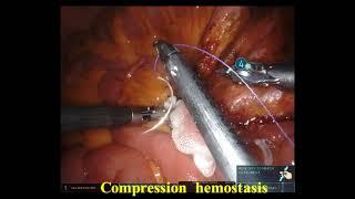 Root of inferior mesenteric artery bleeding during roboticD3 lymph node dissection for rectal cancer