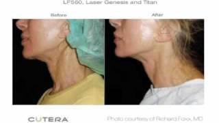 Skin Perfect Medical - Cutera 3D Skin Rejuvenation