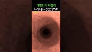 대장암이 퍼질 때 나타나는 증상 3가지! #건강 #건강정보