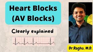 Heart blocks | AV Nodal blocks | Abnormal ECG |  Cardiology