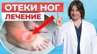 Что делать, если отекают ноги? 5 причин и способы лечения отека ног