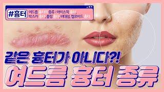 여드름흉터 종류에 따라 치료와 시술 방법이 달라져야 되는 이유