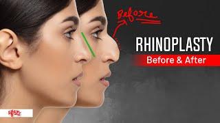 “What to Expect from Rhinoplasty: The Ultimate Guide”