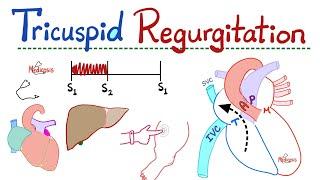 Tricuspid Regurgitation (TR) - Valvular Heart Disease (VHD) - Tricuspid Valve Insufficiency - Cardio