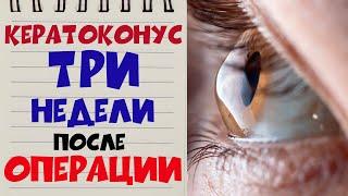  КЕРАТОКОНУС ‍️ Через 3 НЕДЕЛИ после операции на обоих глазах в клинике Арцыбашева 