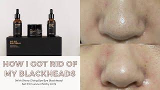 How I remove my stubborn blackheads with Shero Ching Bye Bye Blackhead set