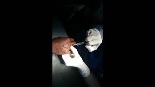 PIP joint dislocation, reduced under local anaesthesia, Adamya Hospital videos