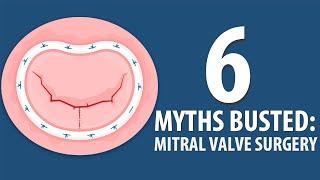 6 Mitral Valve Surgery Myths Busted!