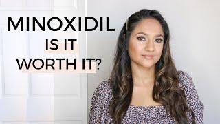 Is Minoxidil GOOD for Hair GROWTH?