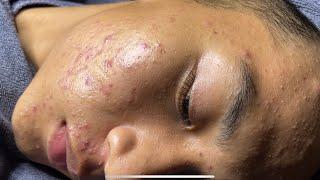 Blackheads & Pimples Pore Removal New 2024 | Acne Treatment With  Bo Nguyễn Spa