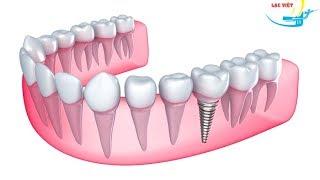 Quy trình trồng răng Implant tại nha khoa Lạc Việt