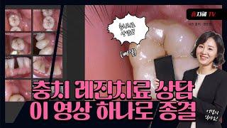 충치치료 레진 상담하셔야 한다면, 이번 영상으로 고민 끝!!