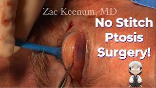 No Stitch Ptosis! - New Surgery. No Scar, No Stitch