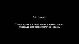 Ультразвуковая анатомия молочных желез. Фиброаденома