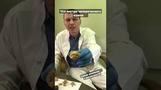Разбиваем огромный камень из мочевого пузыря #мкб #камни #уролог