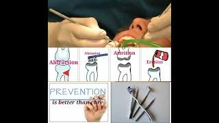 Preventive Measures for Tooth Wear// Attrition, Abrasion, Abfraction, Erosion