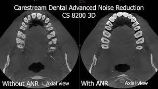 Carestream Dental Advanced Noise Reduction