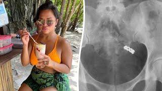 X-ray shows woman's wedding ring after she accidentally swallowed it | SWNS