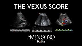 VExUS Score Made Simple!