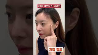 30대 미니거상 한달 후 #팔자주름 #볼처짐 #입가주름 #얼굴처짐 #facelifts #모즈클리닉 *모든 시술/수술은 부작용이 있을 수 있습니다.