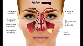 Bài thuốc chữa viêm xoang được hàng trăm ngàn người khuyên dùng | Lương y Triệu Thị Thanh