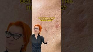 Топ 4 средства против пигментации: 1. АзиксДерм2. Скиноклир3. Имофераза 4. Азелик #косметолог #акне