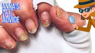 Painful, raised nails after gel polish [Anna's Nail Advice]