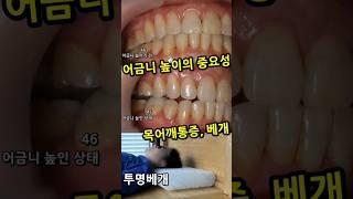 어금니높이가 낮은 환자. 턱관절 불편한 교정부작용 환자 치료하기. 베개도 써야 목어깨통증 해결됨. 목어깨통증환자는 베개도 잘 써야함 (간접광고포함) 20_2024_07_19