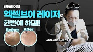 홍조/색소/혈관 엑셀브이 레이저로 진짜 제거가 가능할까? 엑셀브이 레이저 시술 과정 전부 보여드립니다!