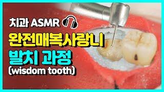 사랑니 뽑는 과정 완벽 공개 | 고품격 치과 ASMR | 당신이 아~한 사이에