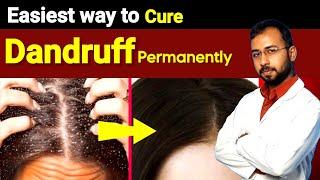 How to get rid of Dandruff permanently | Dandruff treatment at home in English | Dandruff removal