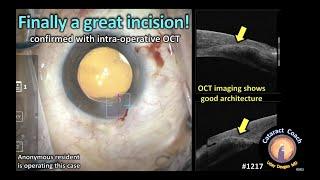CataractCoach 1217: finally a great phaco incision for cataract surgery (OCT)