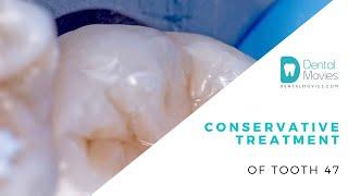 Conservative treatment of tooth 47