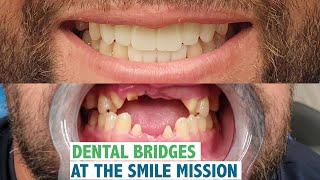 Dental Bridges At The Smile Mission