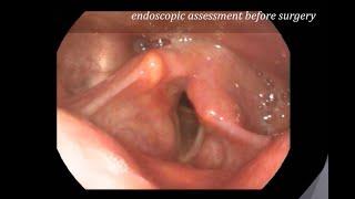 Injection Thyroplasty To Improve Voice In Vocal Cord Palsy